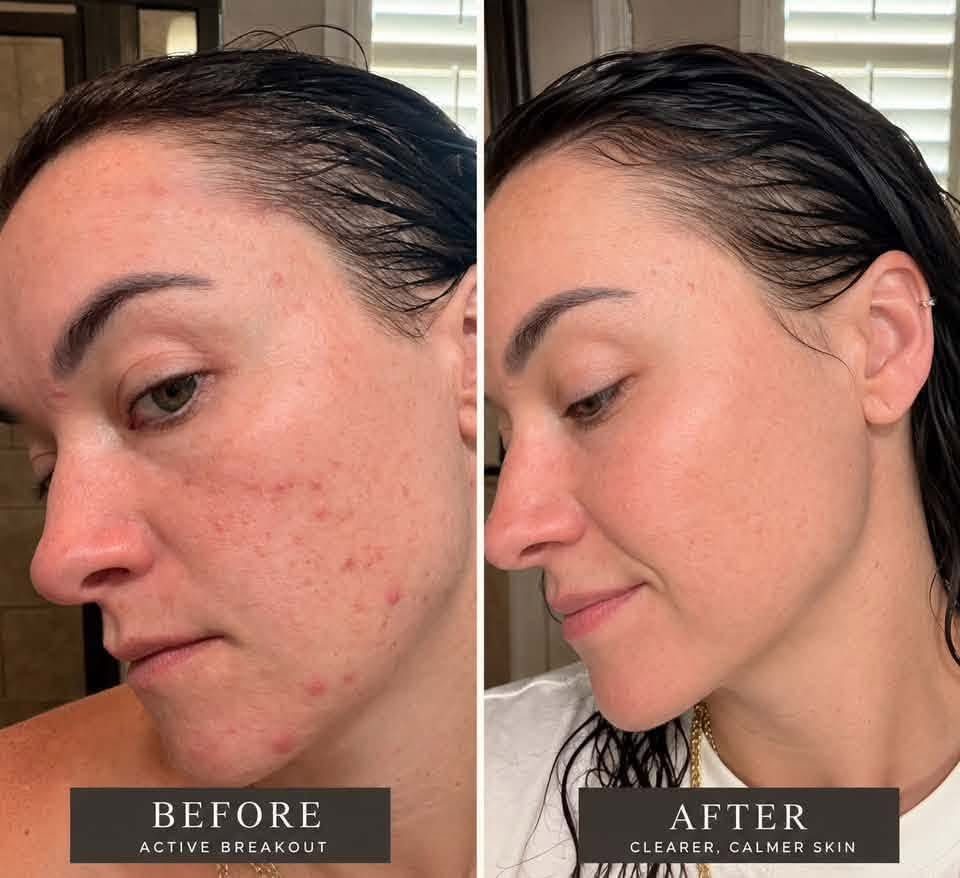 Active breakout → clearer, calmer skin